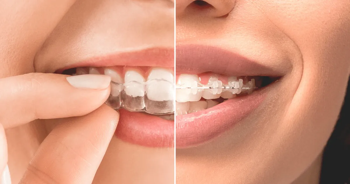 Diferencia entre alineadores invisibles y brackets