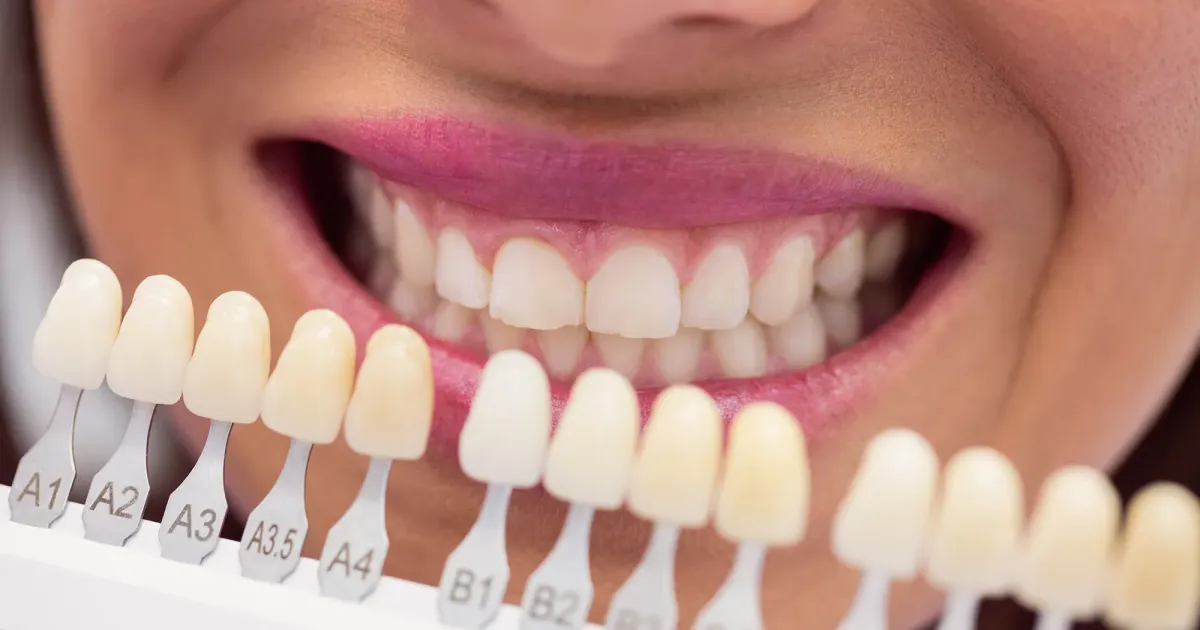Comparación de tonos de carillas dentales con guía de colores sobre la sonrisa de una paciente