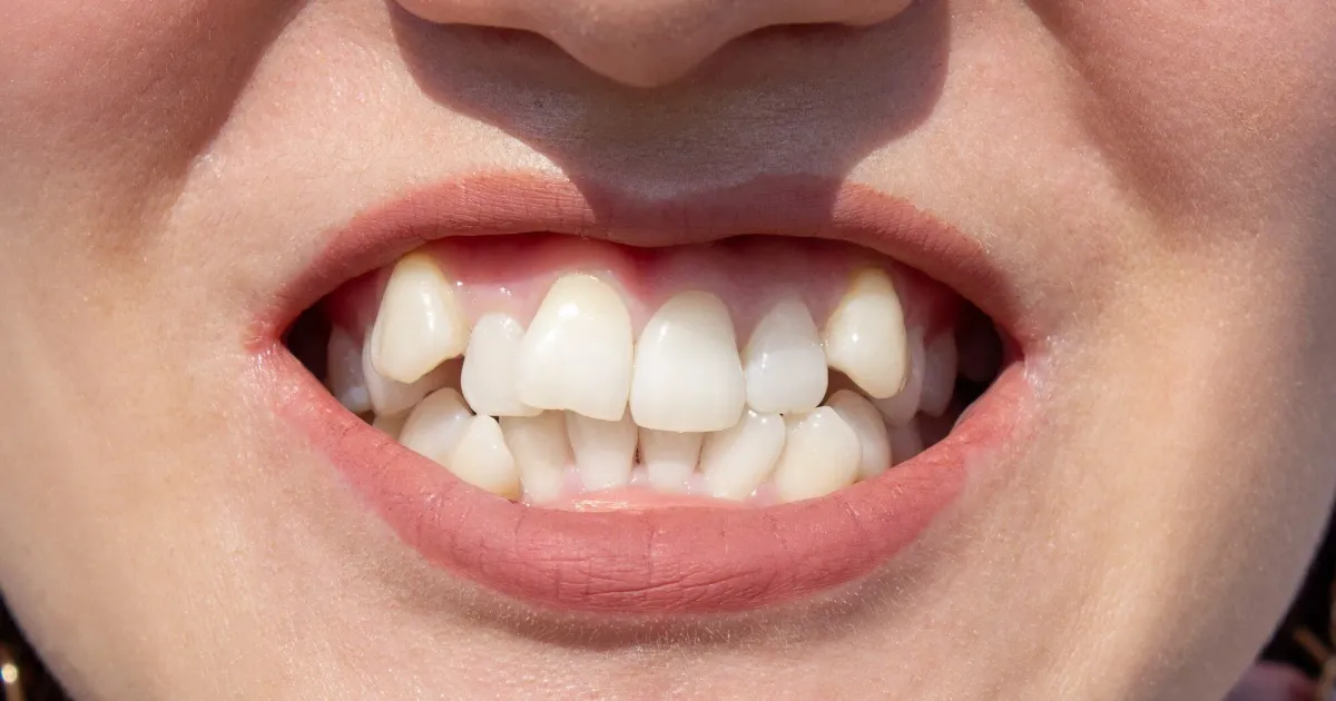 Una sonrisa con apiñamiento dental