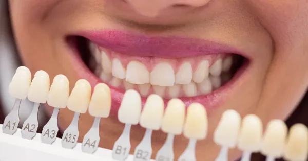 Comparación de tonos de carillas dentales con guía de colores sobre la sonrisa de una paciente