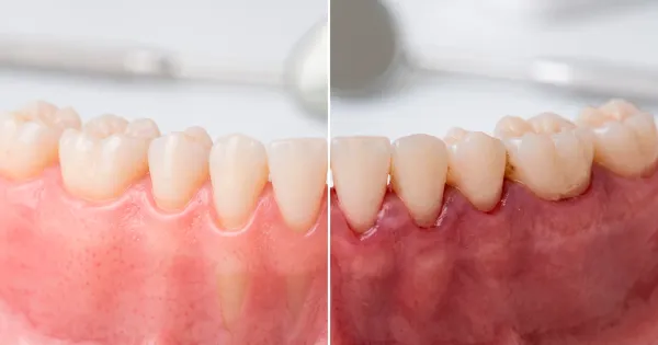 Diferencias entre Gigivitis o periodontitis