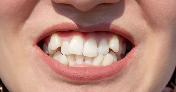 Una sonrisa con apiñamiento dental
